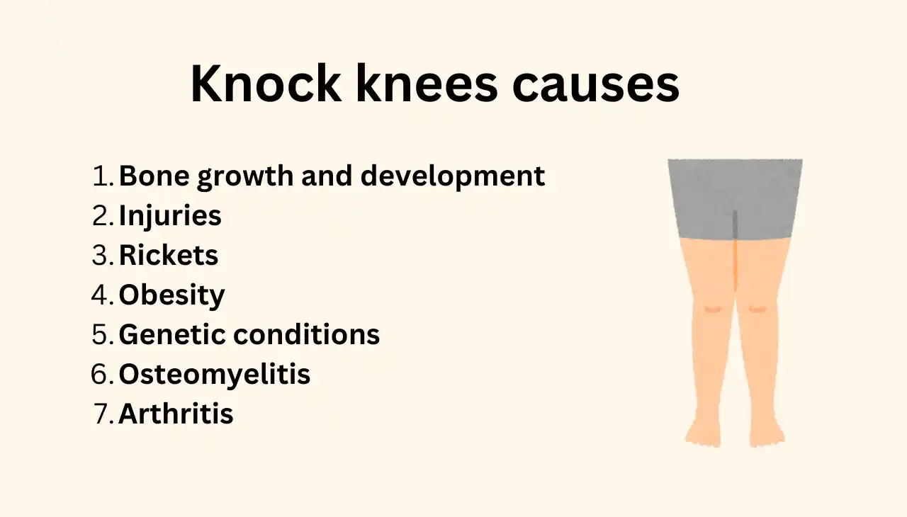 Knock knees causes